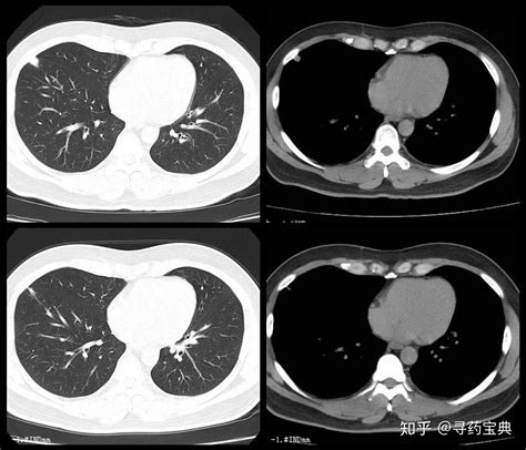 健康的肺部ct图片描述