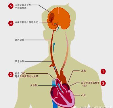 房颤的健康教育