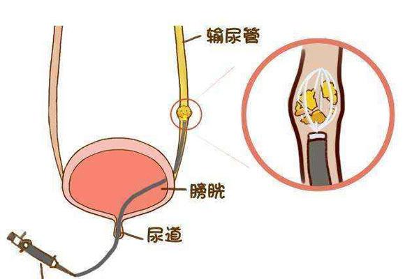 男性尿结石的症状严重吗