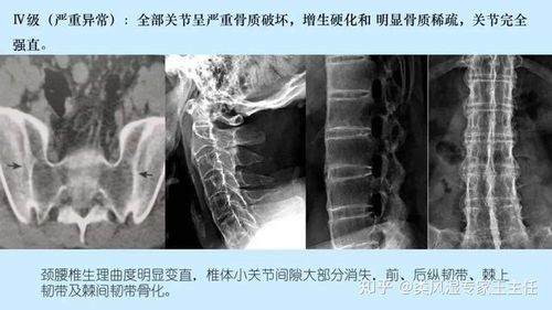 强直性脊柱炎的症状和治疗