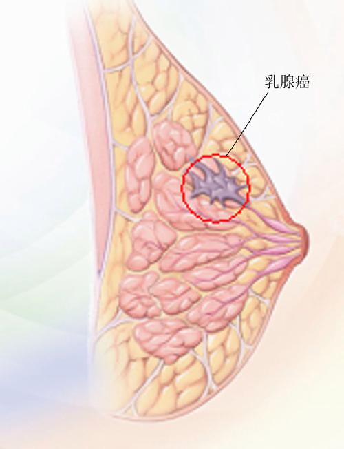 乳腺癌的症状表现有哪些