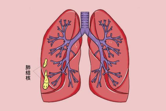 揭秘肺结核的五大常见症状，你了解几个？