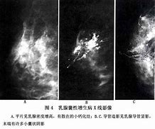 乳腺增生的早期症状是怎么样子