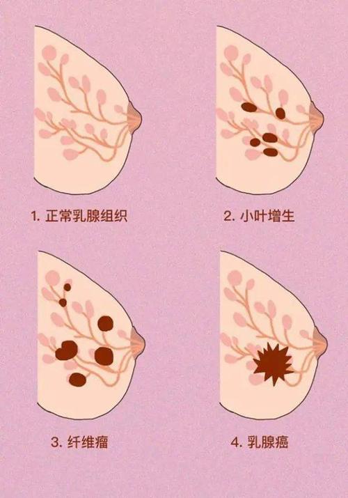 乳腺增生症状了解、识别与应对