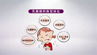 关注健康，早发现早治疗乳腺癌早期症状图片解析