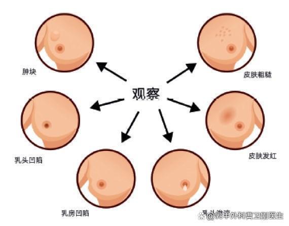 乳腺癌什么症状?