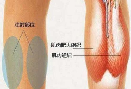 瘦腿针副作用解析