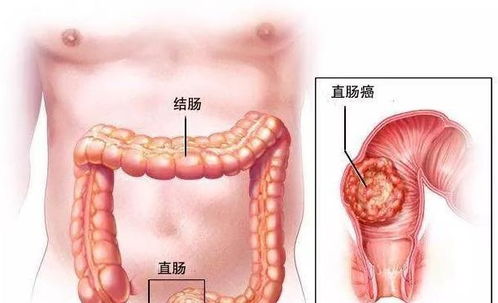 痔疮前期症状如何及早发现并预防？