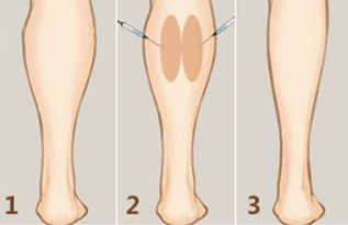 瘦腿针安全吗有没有副作用