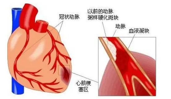 心肌梗死死亡的症状